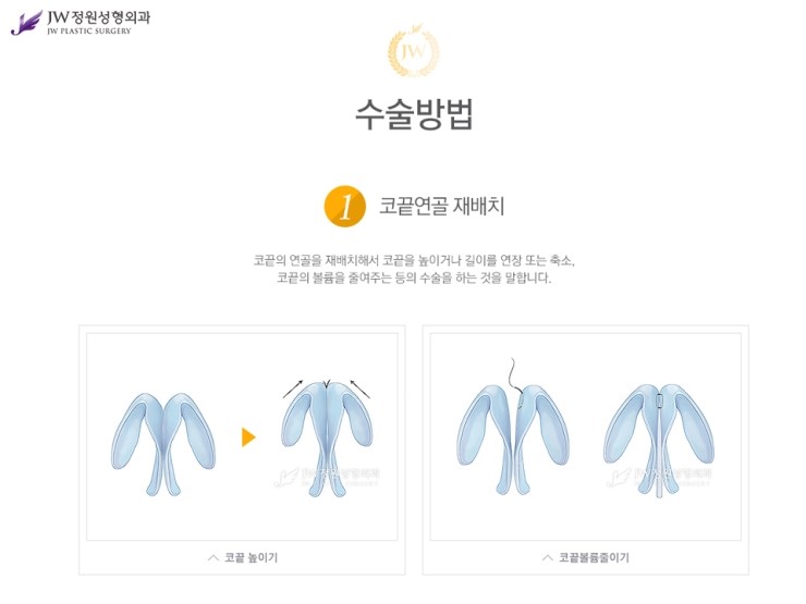 [JW정원성형외과] 코끝성형비용 보다 중요한건 코끝성형결과! 관련 이미지 5