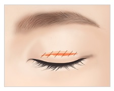 눈재수술! 병원선택부터 신중하게! JW정원성형외과 쌍꺼풀 재수술 관련 이미지 4