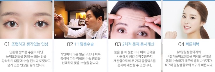 졸려 보이는 눈, 답답한 눈매 JW정원성형외과 눈매교정술로! 관련 이미지 4