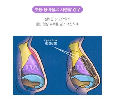강하고 억센 이미지에서 날렵하고 부드러운 이미지로! JW정원성형외과 매부리코 성형 관련 이미지 2