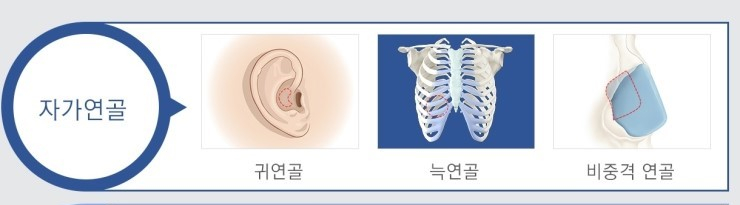 코 구축현상, 그 증상과 해결방법에 대해서 관련 이미지 6