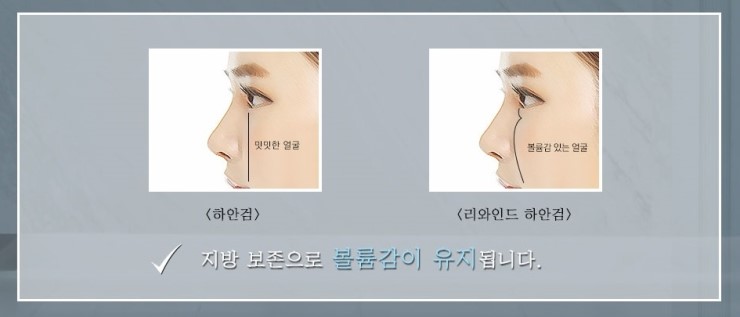 [JW정원성형외과/하안검성형] 불룩한 눈 밑, 현재 인상을 유지하면서 자연스럽게 젊어 지는 방법은? 관련 이미지 11