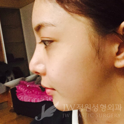 코재수술도 역시 JW정원성형외과 서만군원장 :] 관련 이미지 9