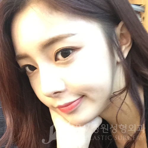 코재수술도 역시 JW정원성형외과 서만군원장 :] 관련 이미지 10