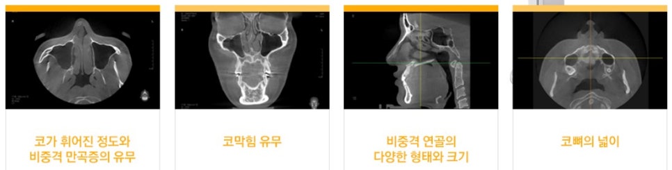 코끝에서 완성되는 아름다움, JW정원성형외과 코끝성형 관련 이미지 6
