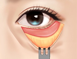 [JW정원성형외과]눈밑지방재배치 vs. 하안검수술, 선택기준은? 관련 이미지 3