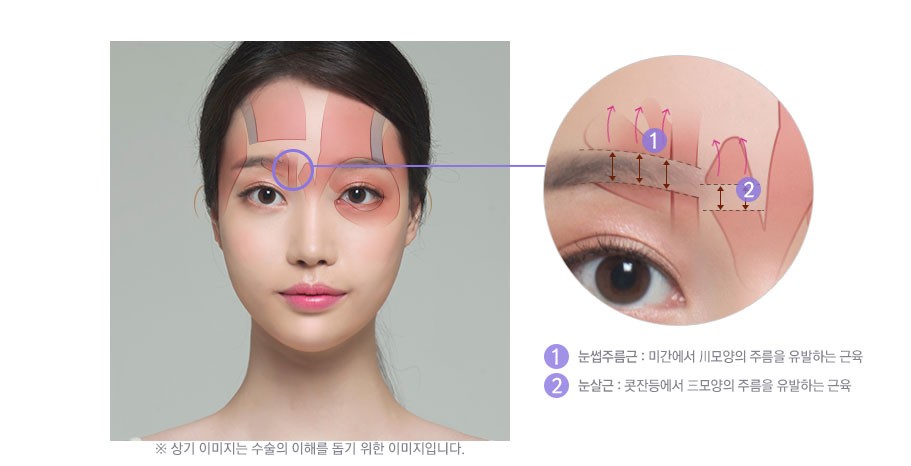 이마거상술, 내시경이마거상으로 안전성과 오랜 지속효과까지 관련 이미지 3