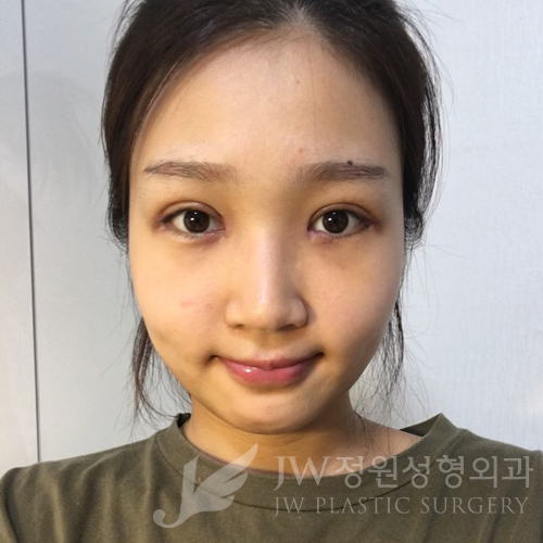 JW정원성형외과에서 매몰쌍꺼풀,앞트임,듀얼트임,코성형,넥리프팅으로 여신효과♡ 관련 이미지 2