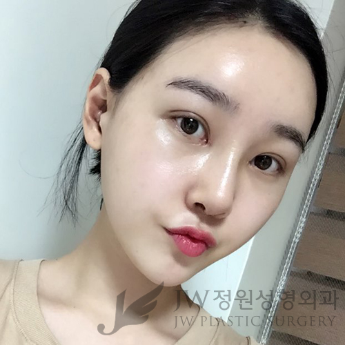 이마눈썹리프팅,눈매교정술,앞트임복원,코성형,지방이식 ⇒ JW정원성형외과에서! 관련 이미지 9