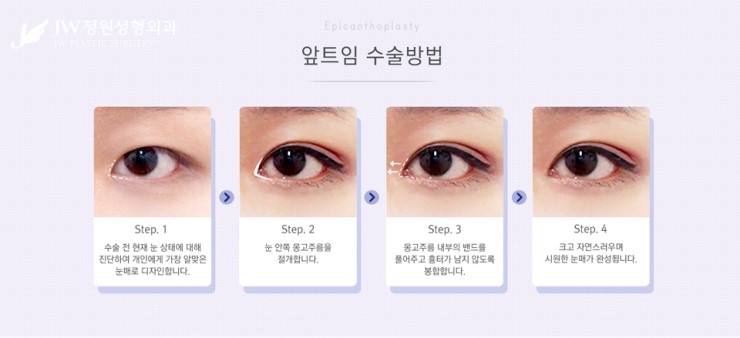 [JW정원성형외과] 시원한 눈매를 완성해주는 트임성형, 트임성형 잘하는 곳에서! 관련 이미지 4