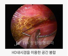안전함과 아름다움을 동시에! JW정원성형외과 가슴재수술 관련 이미지 2