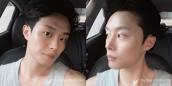 눈+코 성형으로 남성적인 이미지 UP 남자성형도 역시 JW정원성형외과! 관련 이미지 5