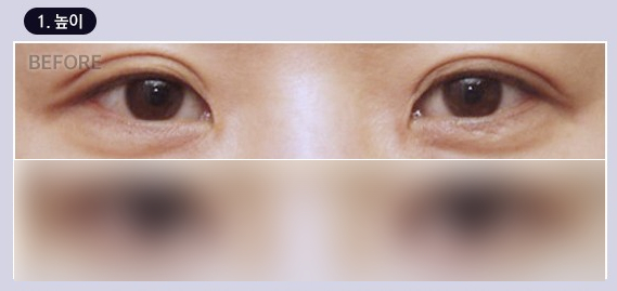 Double Eyelid Line Revision Surgery: Finding a Clinic That Is Good at Eye Revision Surgery image 2