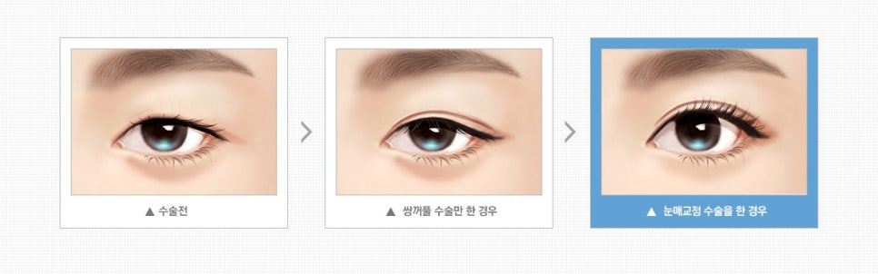 절개/비절개눈매교정, 나에게 맞는 눈매교정술은? 관련 이미지 3