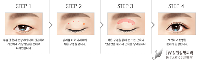 피곤해보이는 졸린 눈을 생기 있게 바꾸는 눈매교정술 관련 이미지 5