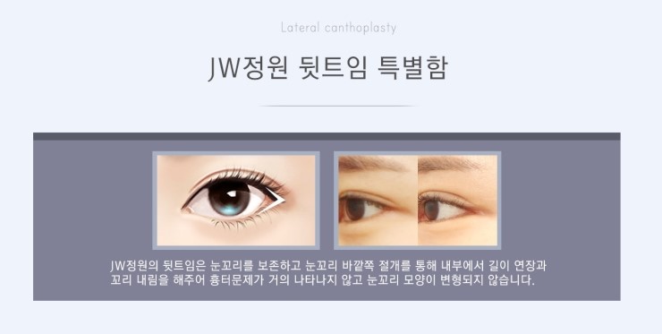 작고 답답한 눈매를 크고 시원스럽게! JW정원성형외과 360° 멀티트임 관련 이미지 7