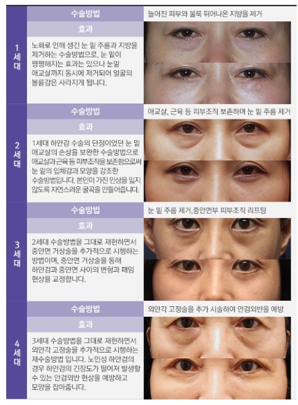 처지고 꺼진 눈밑! JW정원성형외과 리와인드 하안검으로 당기고 채우자! 관련 이미지 3