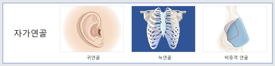 이상적인 코모양의 완성은 비주에서부터, 자가연골로 비주빼기 관련 이미지 7