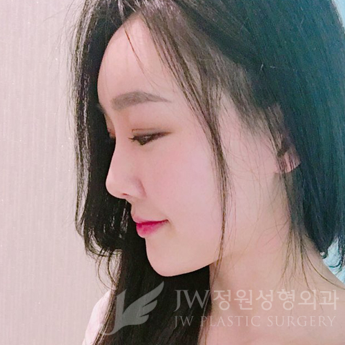 이마눈썹리프팅,눈매교정술,앞트임복원,코성형,지방이식 ⇒ JW정원성형외과에서! 관련 이미지 21