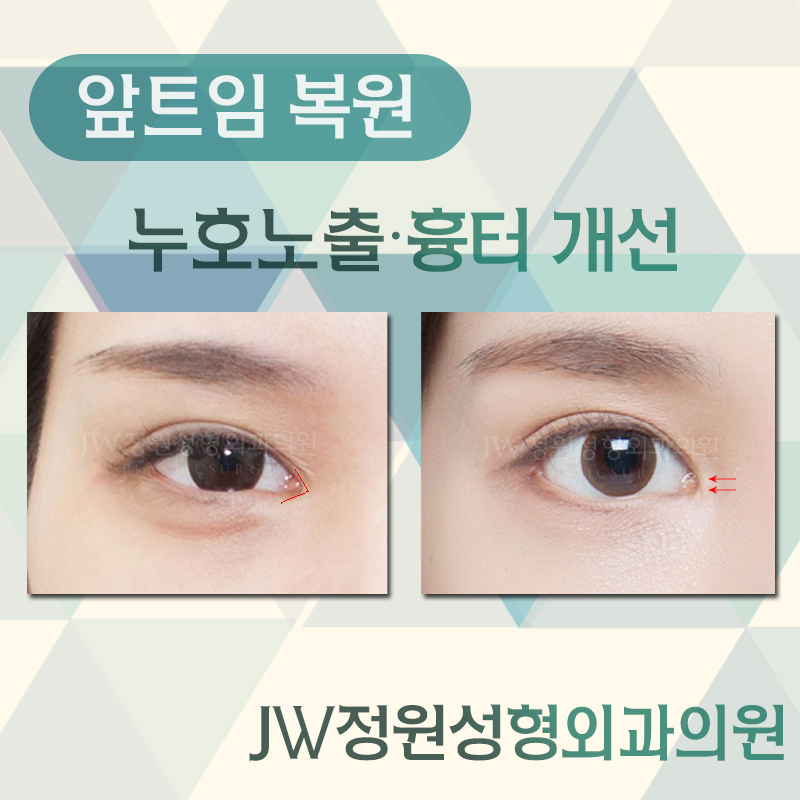 과도한 앞트임, 앞트임재수술, 앞트임복원 잘 하는 병원에서 관련 이미지 3