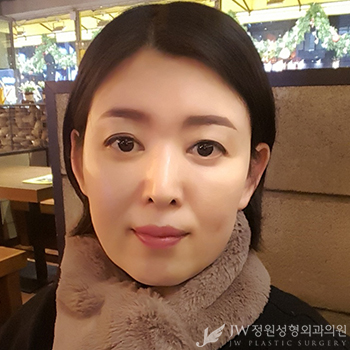 세월의 흔적 JW정원성형외과 이마눈썹거상+리와인드하안검으로 말끔하게♡ 관련 이미지 1