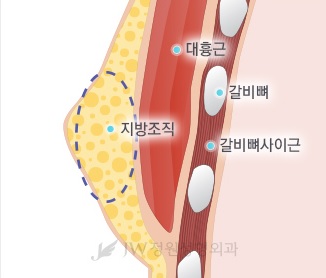 [JW정원성형외과]여유증, 여성형유방 수술로 해결하세요! 관련 이미지 4