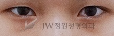 밝고 맑은 인상으로 변신, 눈밑지방재배치! JW정원성형외과에서~ 관련 이미지 3