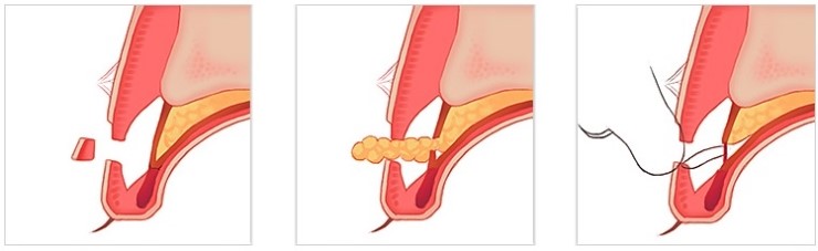 크고 아름다운 나만의 맞춤 쌍꺼풀! JW정원성형외과 쌍꺼풀수술 관련 이미지 5