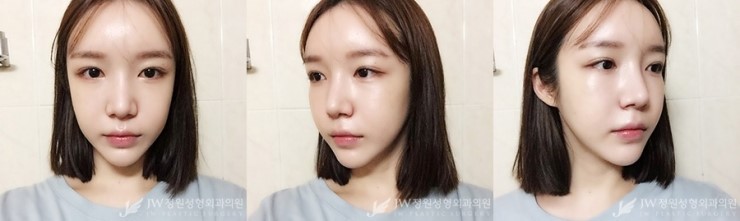 [JW정원성형외과] 지방이식+코재수술로 입체감 있는 얼굴완성♡ 관련 이미지 2