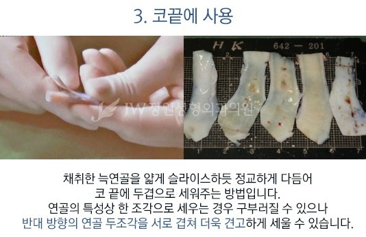 [JW정원성형외과] 코성형, 어려울수록 자신 있습니다! 관련 이미지 6