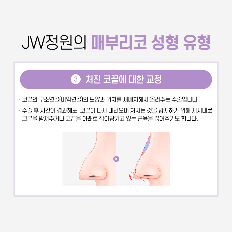 Hump Nose Surgery Cost: If You Want a Softer Line image 7