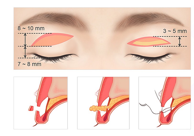 나에게 맞는 쌍꺼풀은? JW정원 쌍꺼풀수술 관련 이미지 5