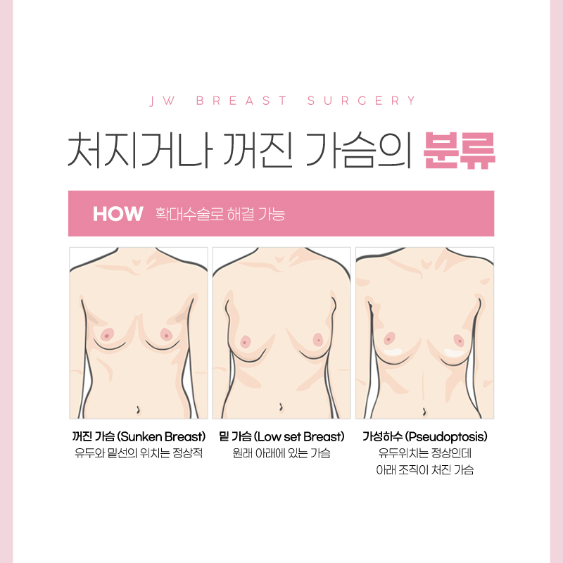 Breast Lift Surgery Cost: An Appropriate Method for Sagging Breasts? image 2