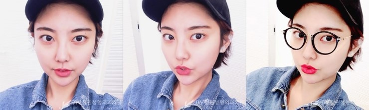 울퉁불퉁한 얼굴라인&rarr;JW정원지방이식으로 매끈하게! 관련 이미지 5