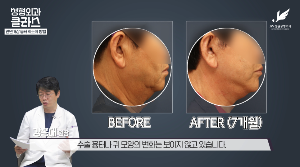안면거상술후기 흉터 걱정 없이 깔끔하게!  【강남 JW정원성형외과】 관련 이미지 20