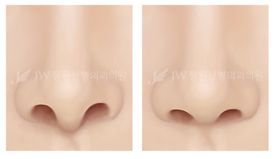 촌스러운 이미지에서 세련된 인상으로! JW정원성형외과 콧날개교정술 관련 이미지 9