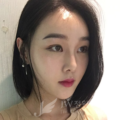 이마눈썹리프팅,눈매교정술,앞트임복원,코성형,지방이식 &rArr; JW정원성형외과에서! 관련 이미지 14