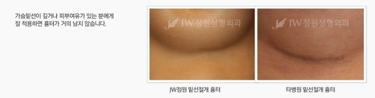 보형물+지방이식 장점만을 담은 JW정원성형외과 콤비네이션 가슴확대 관련 이미지 8