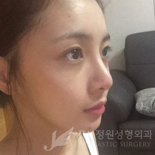 코재수술도 역시 JW정원성형외과 서만군원장 :] 관련 이미지 12