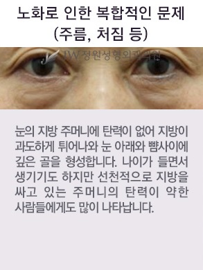 울퉁불퉁한 눈 밑, 피곤해 보이는 눈 밑 JW정원 눈밑지방재배치로 고민 해결! 관련 이미지 4