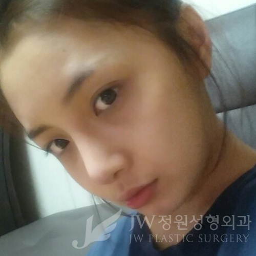 코재수술도 역시 JW정원성형외과 서만군원장 :] 관련 이미지 3