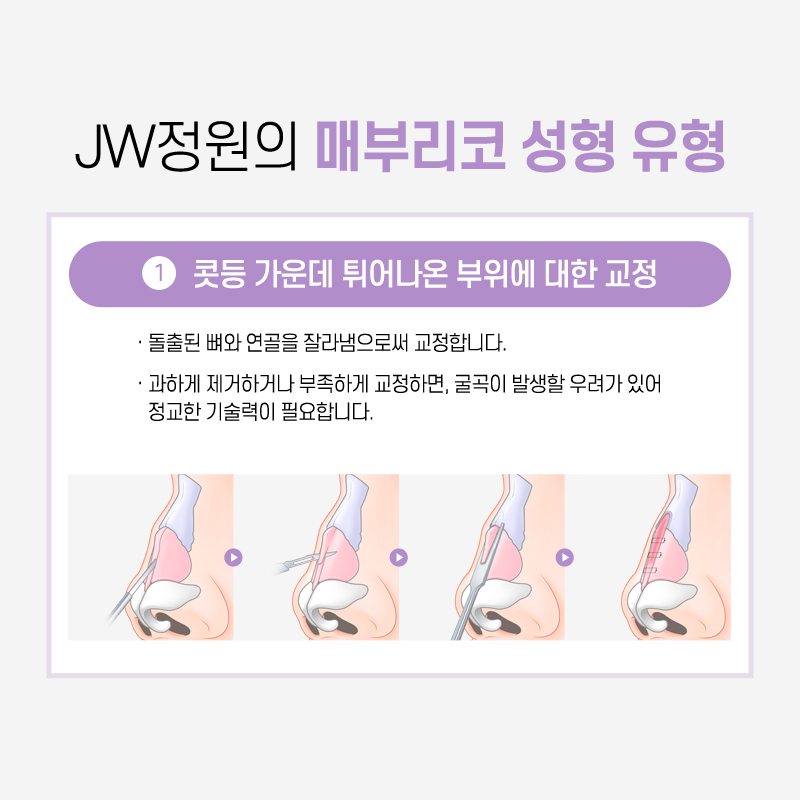 Hump Nose Surgery Cost: If You Want a Softer Line image 4