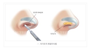 내 얼굴의 중심, 황금비율로! JW정원성형외과 짧은코성형 관련 이미지 8