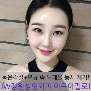 묵은 각질과 모공 속 노폐물 제거! JW정원성형외과 아쿠아필로 말끔하게! 관련 이미지 1