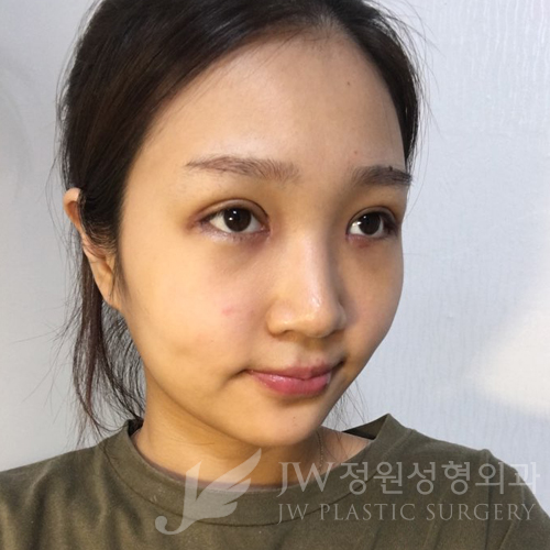 JW정원성형외과에서 매몰쌍꺼풀,앞트임,듀얼트임,코성형,넥리프팅으로 여신효과♡ 관련 이미지 3