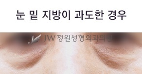 Best Place for Under-Eye Fat Repositioning, with a Surgical Method Suited to My Under-Eyes image 2