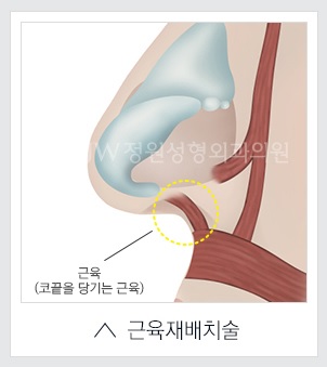 [JW정원성형외과] 코성형, 어려울수록 자신 있습니다! 관련 이미지 16