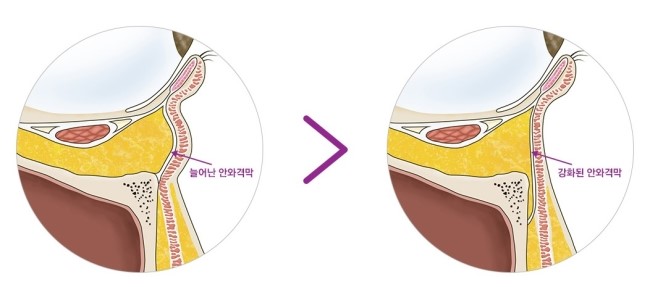 울퉁불퉁한 눈 밑, 피곤해 보이는 눈 밑 JW정원 눈밑지방재배치로 고민 해결! 관련 이미지 5