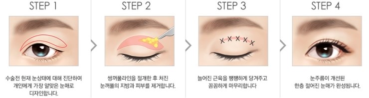 처진 눈꺼풀, 상안검 성형으로 시야 개선과 젊은 눈매를 동시에! 관련 이미지 2