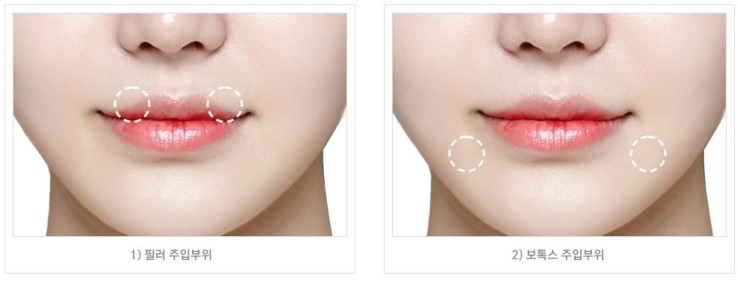 아름다운 미소의 완성! JW정원성형외과 입꼬리 성형 관련 이미지 4